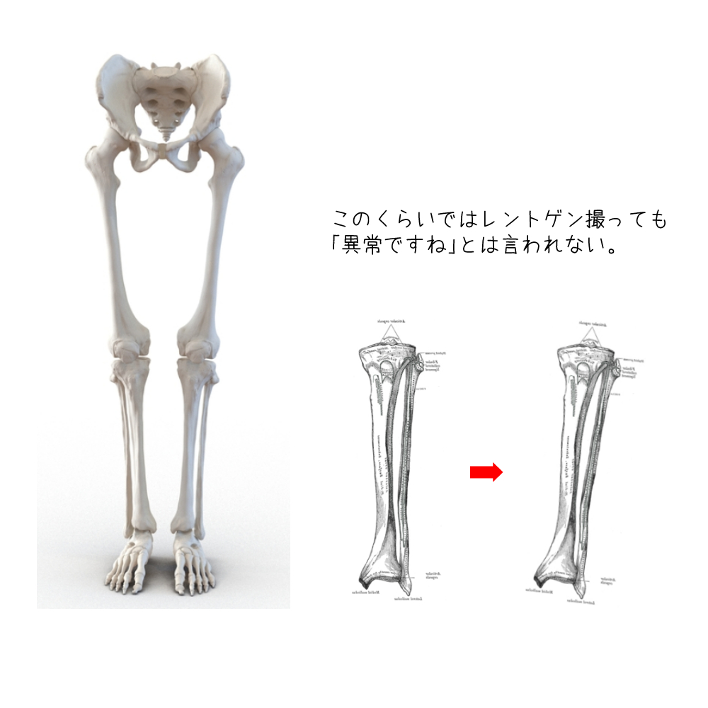【脛骨腓骨の歪み】の説明図