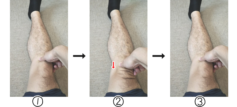 膝蓋骨上部の軟部組織の治療図