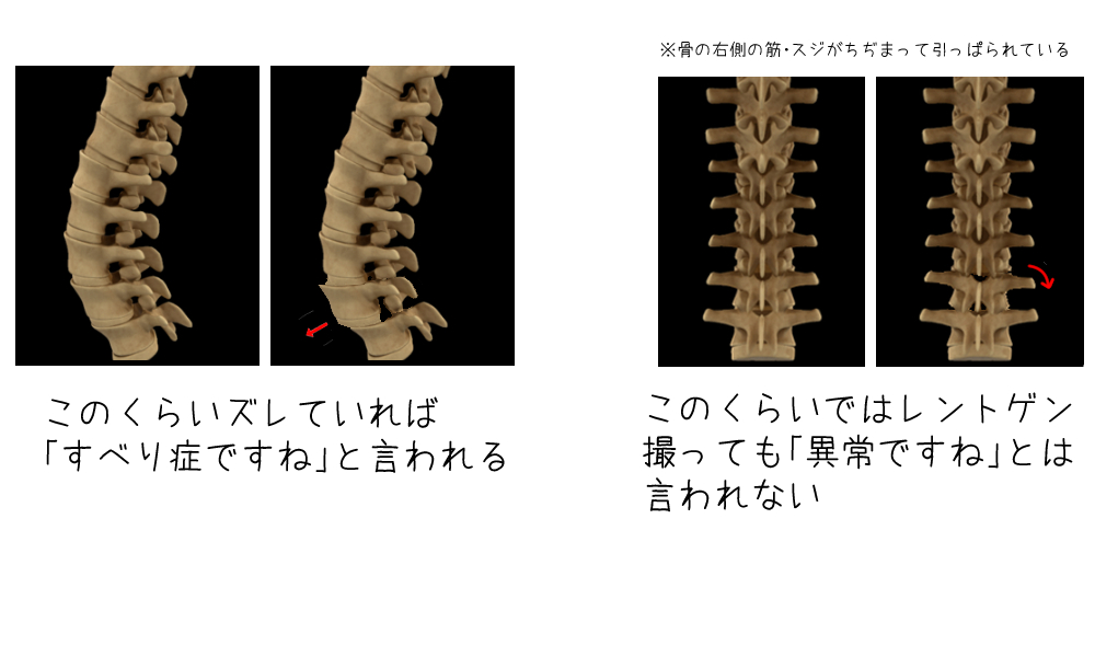 腰椎の痛みの説明図