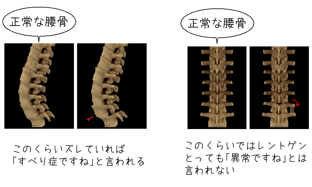 腰椎のズレ説明図