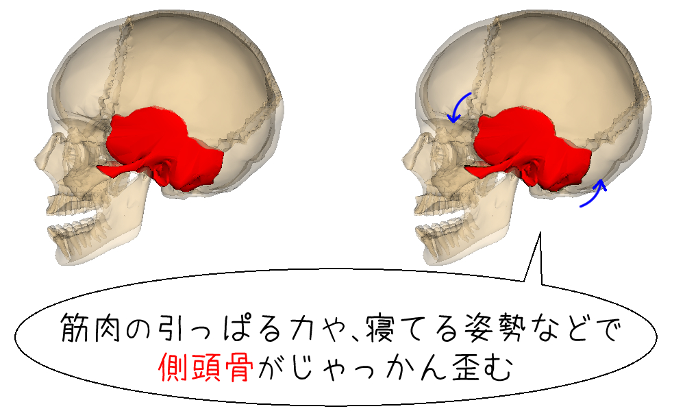 側頭骨の歪みの説明