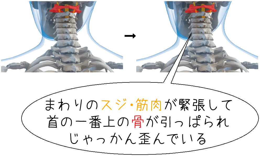 第一頚椎の歪みの説明図