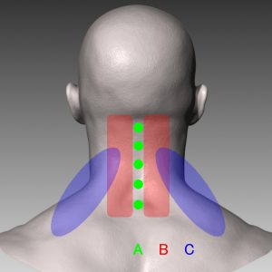 首の痛み分類図