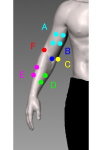 肘の痛み分類図